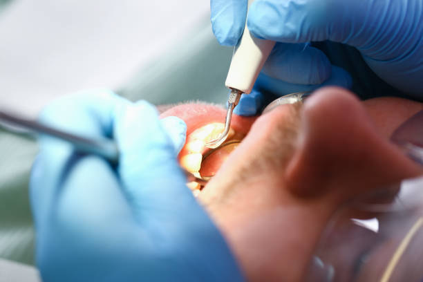 Best Emergency Tooth Extraction in Vaville, CA